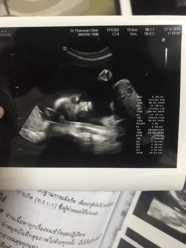 น้ำหนักทารกในครรภ์