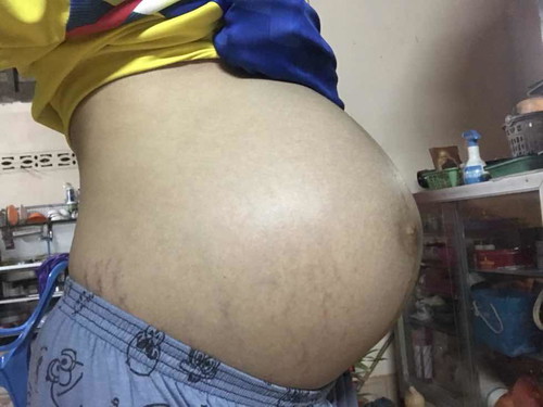 33w5d กำหนดคลอด3เมษา