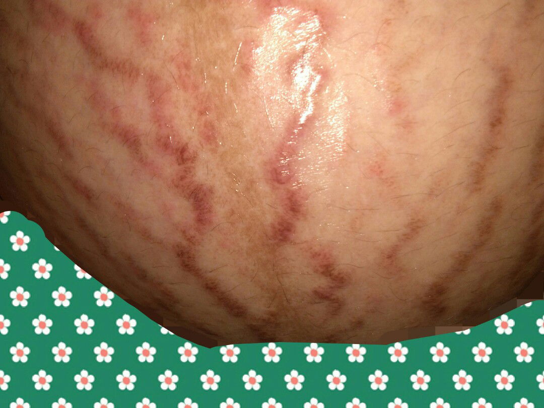 stretchmarks