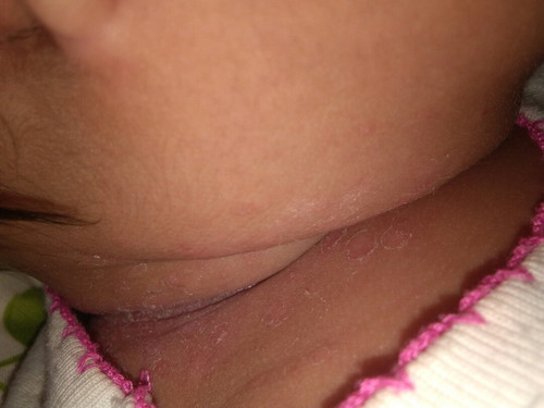 SUDOCREAM for my baby's neck rashes