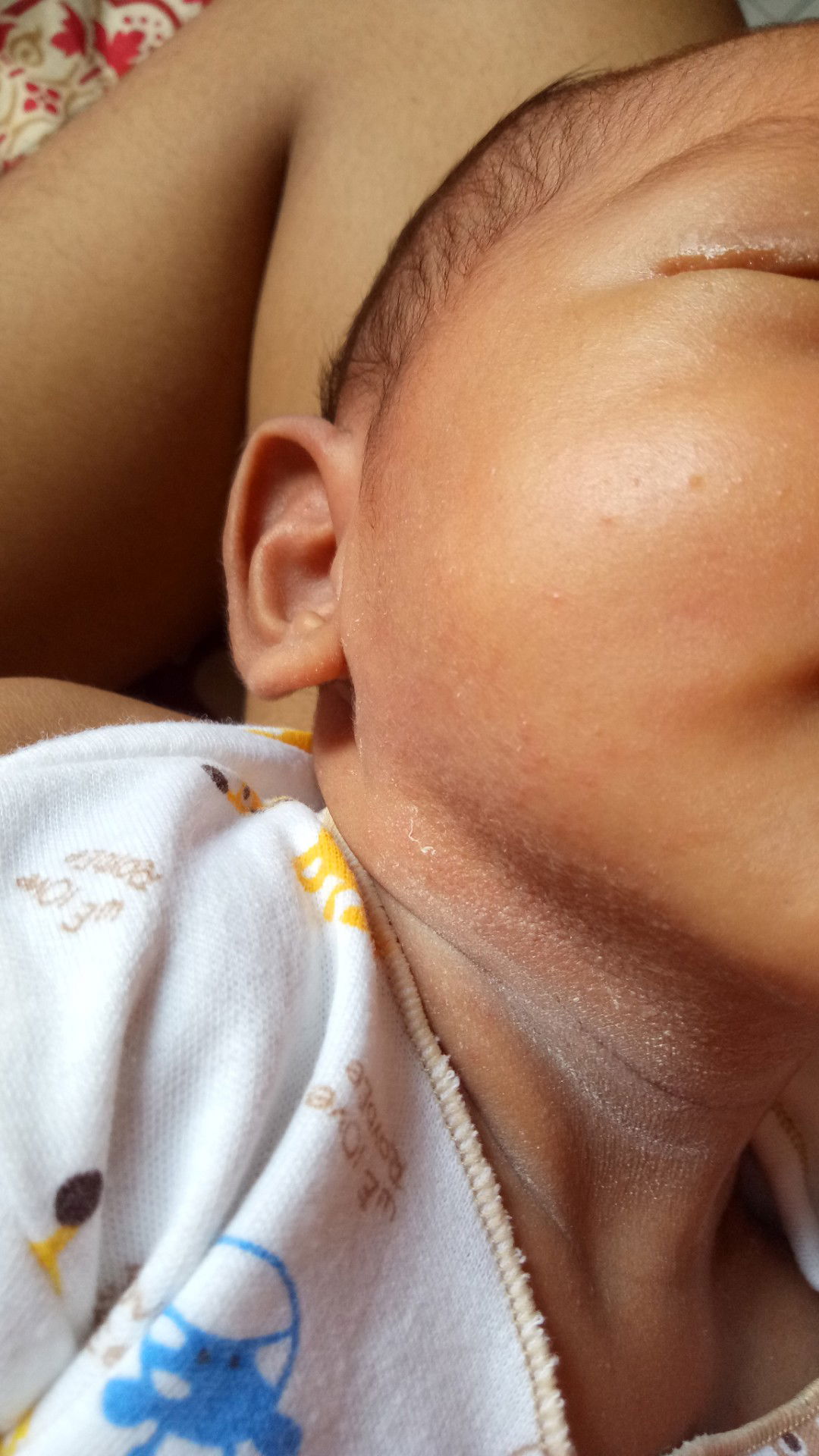 bruntusan pada bayi!!! URGENT