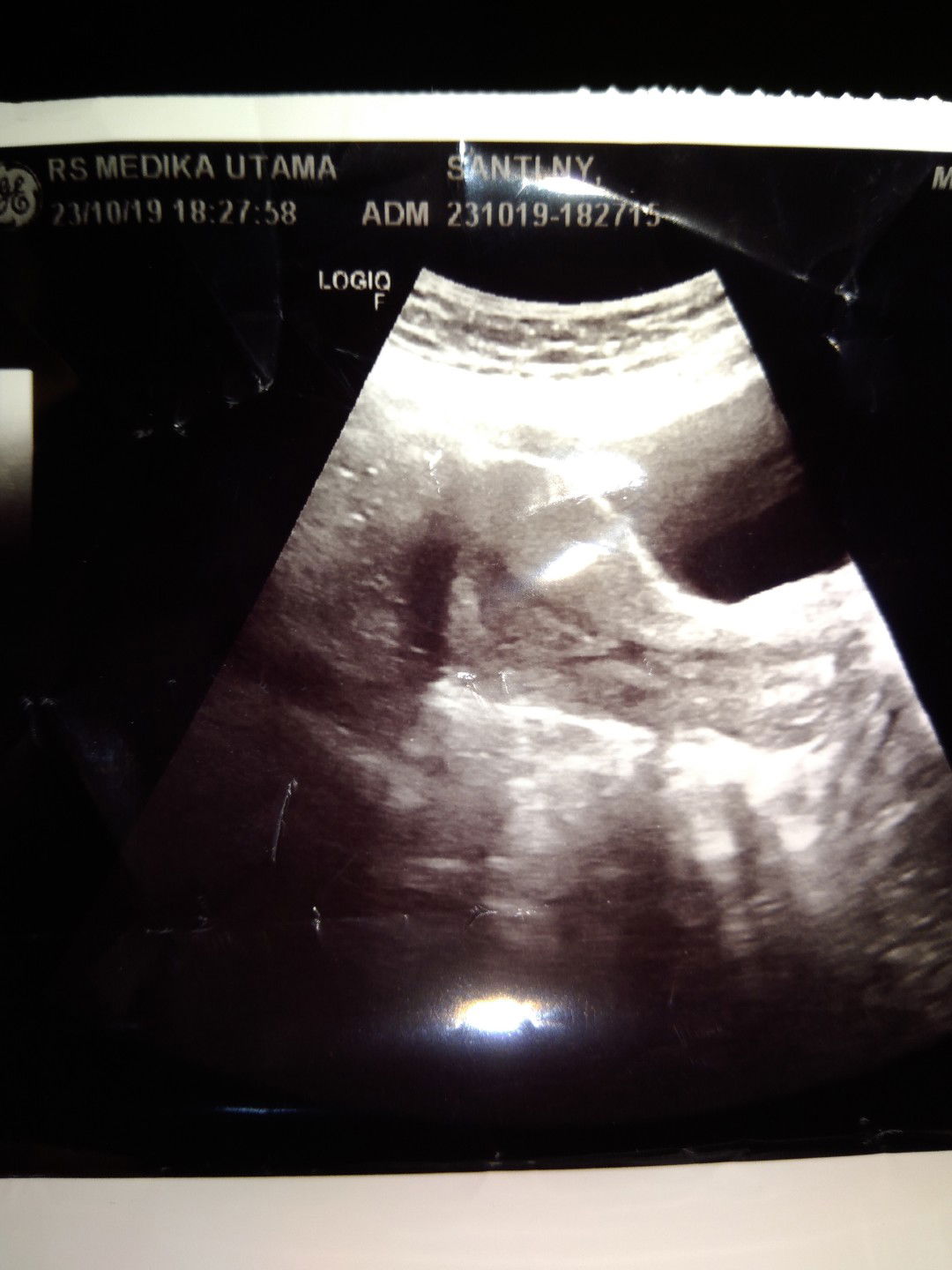 test pack positif usg belum kelihatan kantung kehamilan