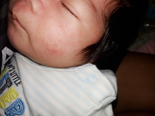 ลูกเป็นผดแดงๆใช้อะไรทา
