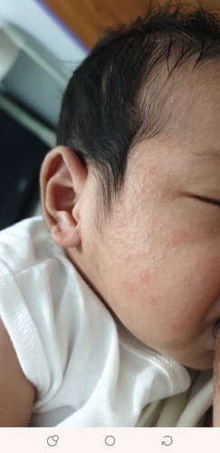 RASHES
