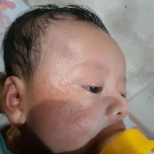 pipi anak bintik merah banyak