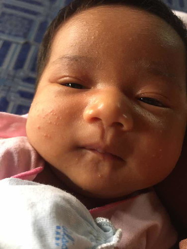 หน้าน้องมีเม็ดเล็กๆขึ้น ทั้งสองแก้ม