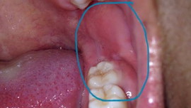 เหงือกบวม บริเวณฟันคุด