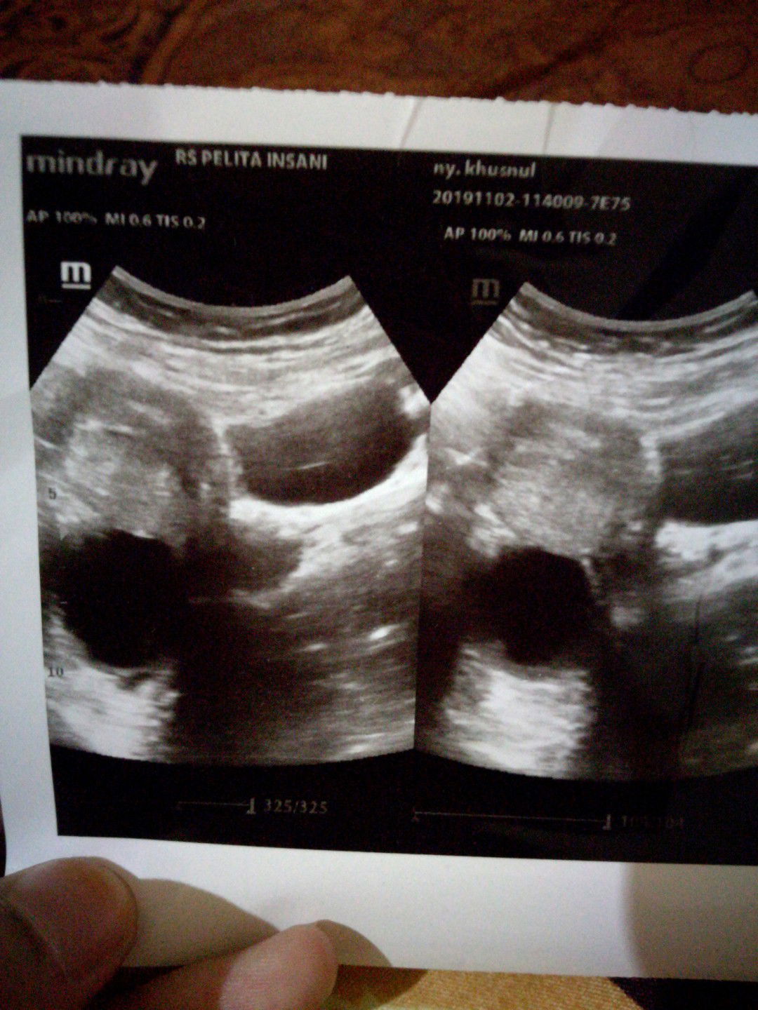 Usg Kehamilan
