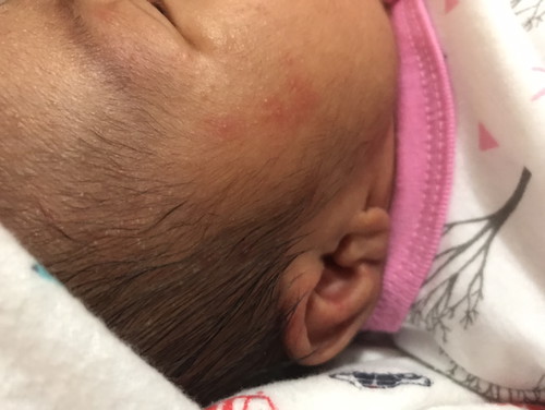 Gatal pd bayi