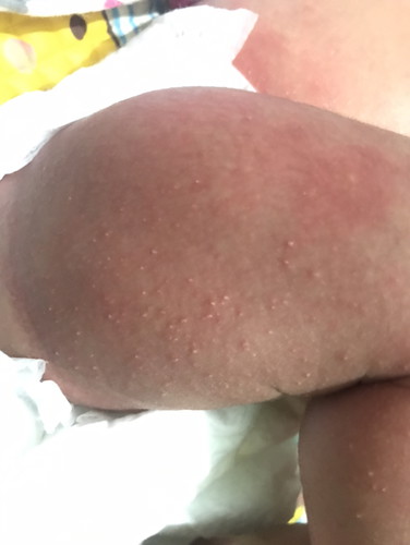 Bintik pd bayi