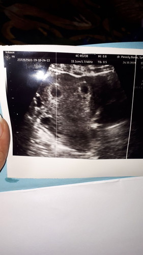 bun aku hamil anak kedua ini . beda bngt sama pertama dulu mual2 terus. kmrin kami check dpt rejeki double anak saya kembar. saya ga doyan makan apapun selalu mual2. bawaanya jg malas mau tdr2an aja drmh.