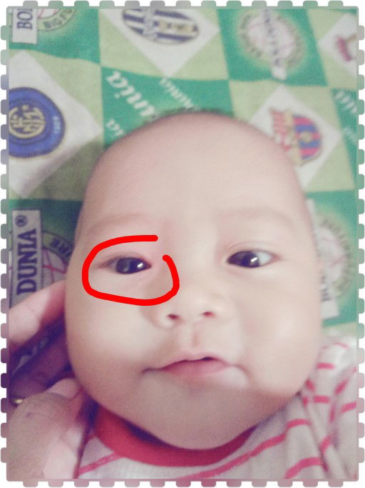 kelopak mata bengkak