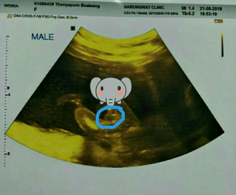 แชร์ประสบการณ์เดาเพศลูกค่ะ