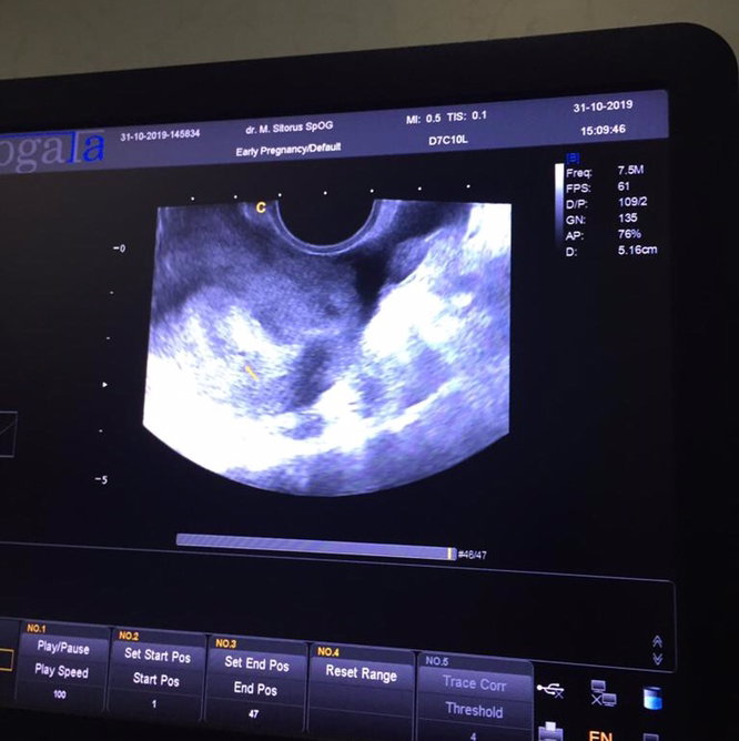 USG TRANSVAGINAL TELAT SEMINGGUAN