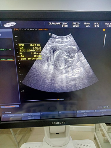 17w2d