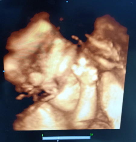 26w1d