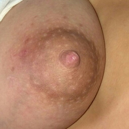 mahapdi sa nipple