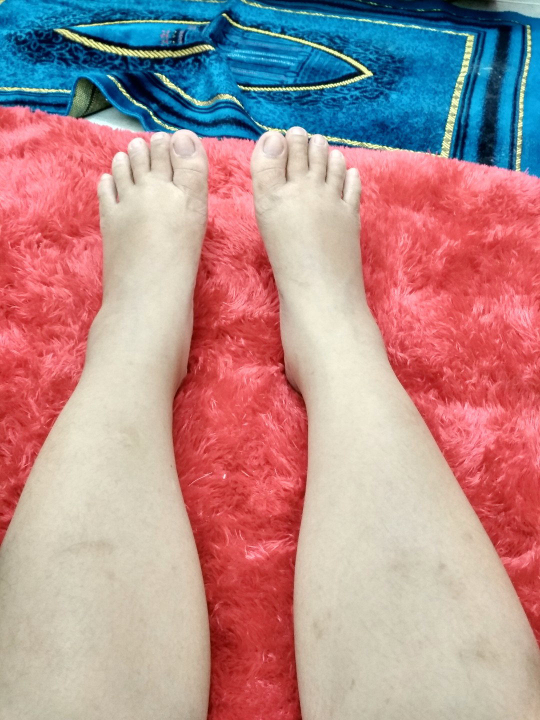 kaki bengkak