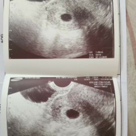 Positive sa PT pero walang laman sa Ultrasound