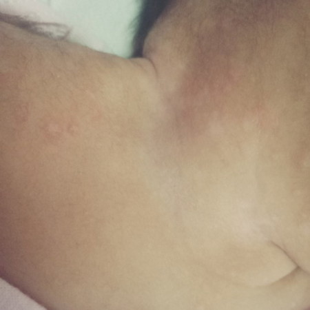Rashes po ba ito?