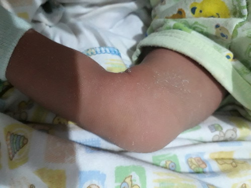 kulit kering