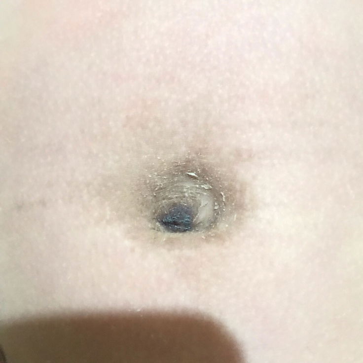 สะดือลูกเป็นแบบนี้ทำไงดีคะ