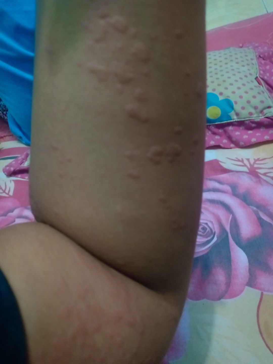 hamil 15 week tiba2 gatal gatal