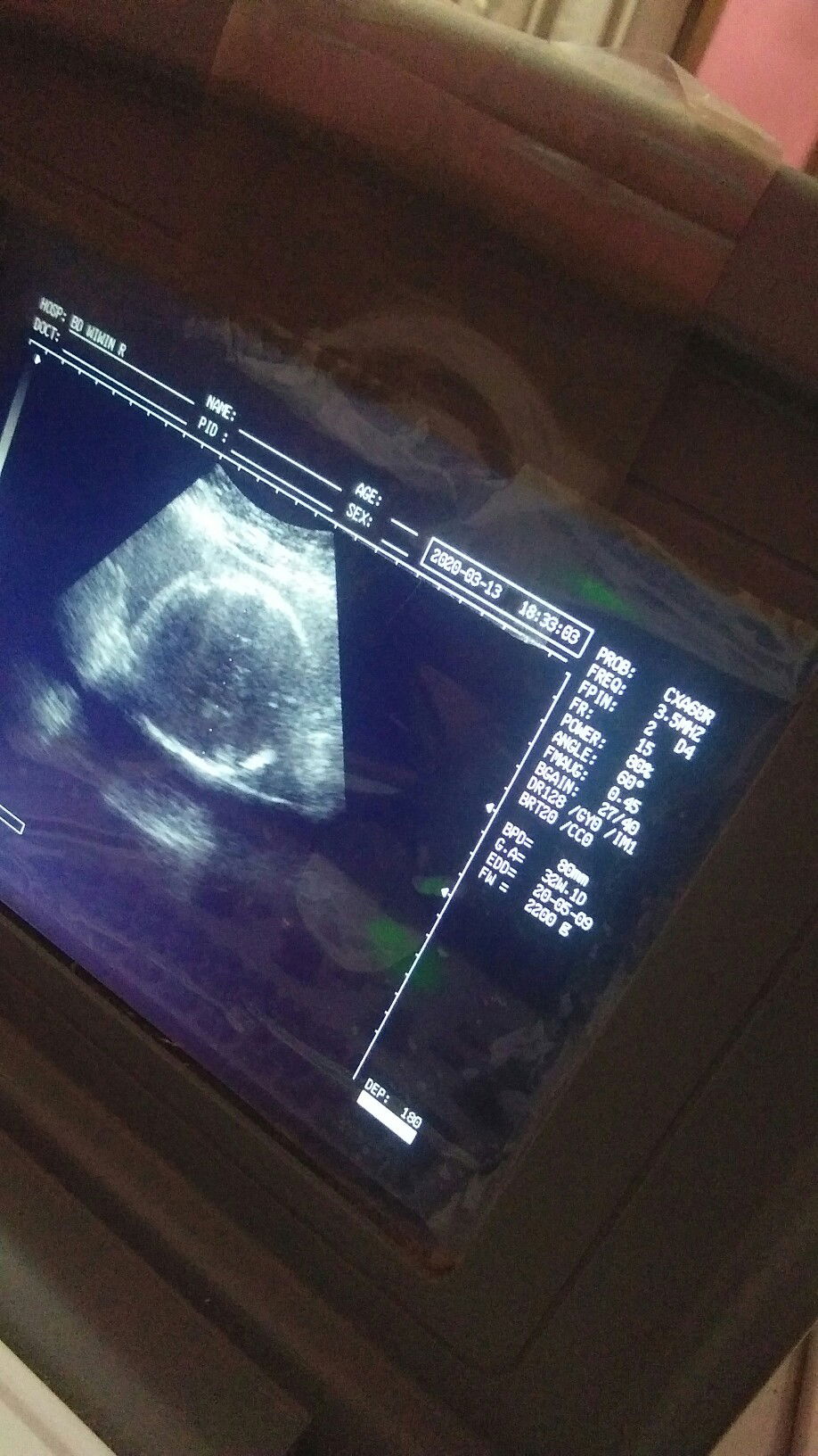 HPL USG BIDAN BERBEDA