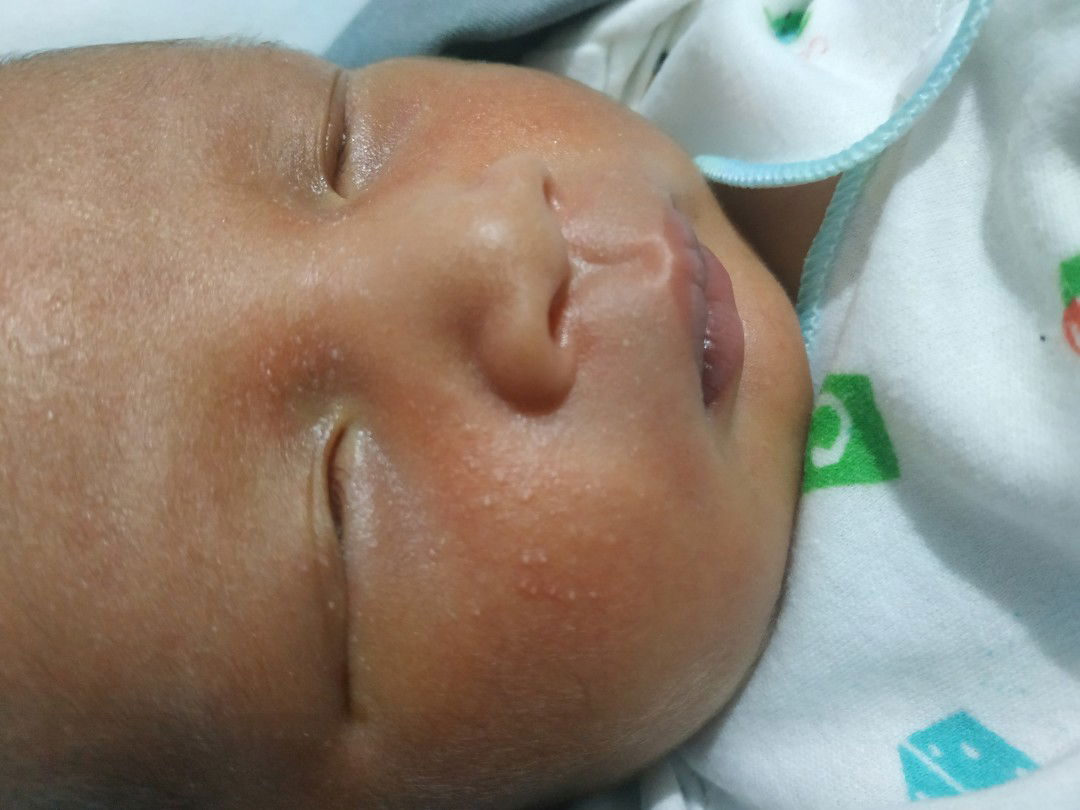 bintik merah di pipi