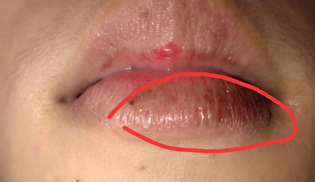 bibir hitam kering gatal