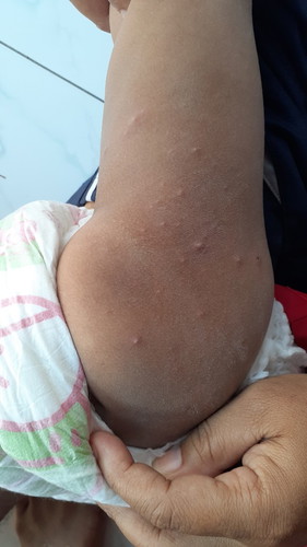 anak balita 2 tahun kena bintik merah dan berair