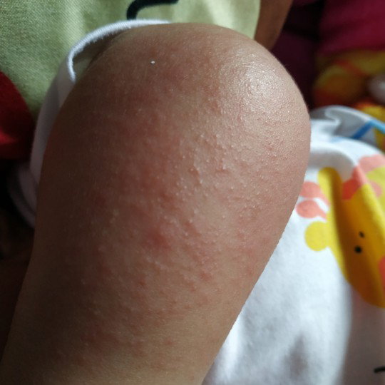 Ruam kulit bayi