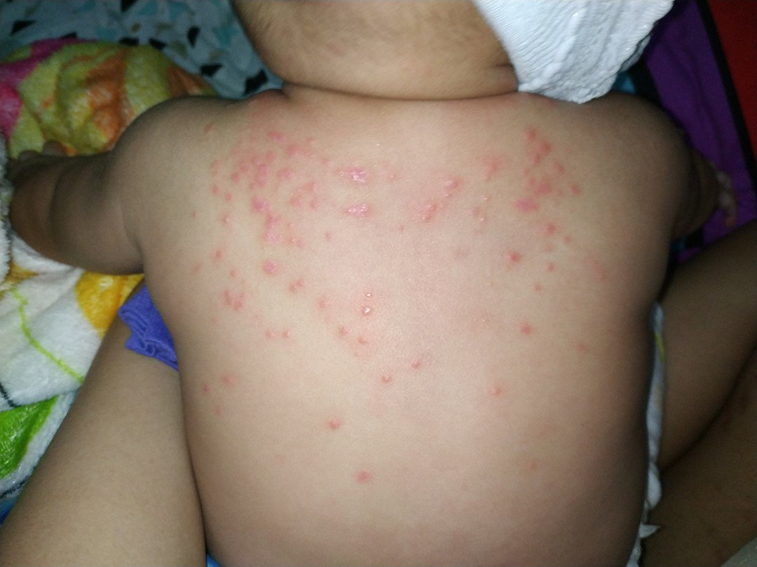 ruam di punggung bayi