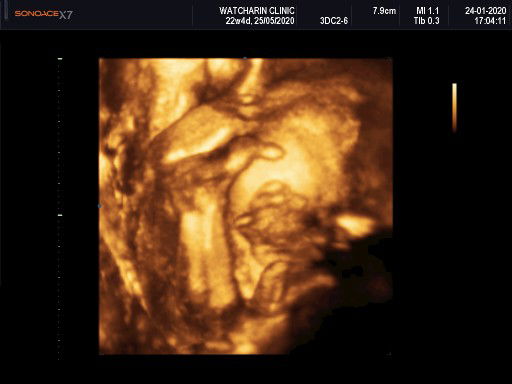 เบาหวานขณะตั้งครรภ์