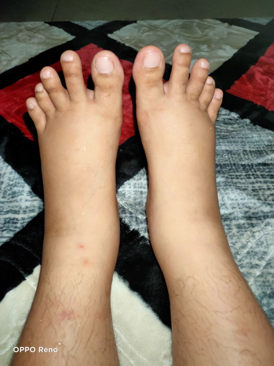 kaki bengkak is normal or not?