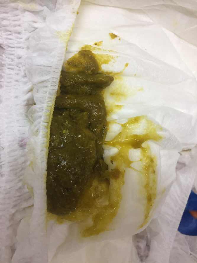 สีอึแบบนี้ผิดปกติไหมคะ