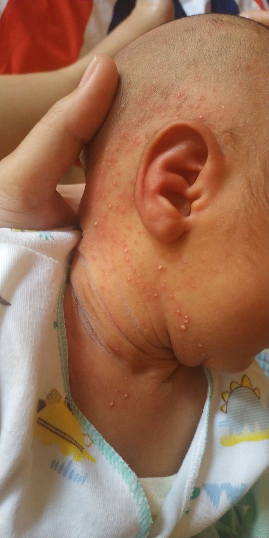 Bintik merah bruntusan