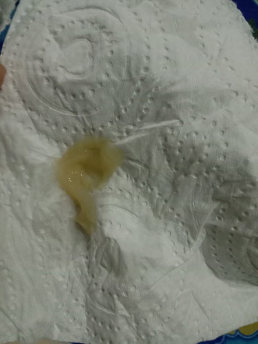 มูกหรือตกขาว