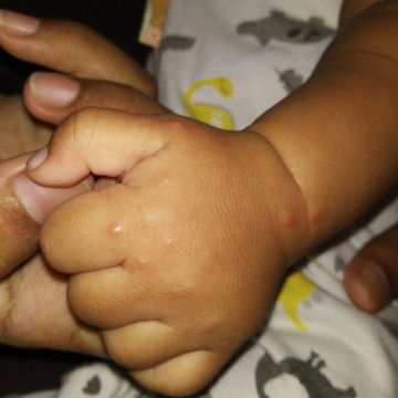 bintik merah seperti berair