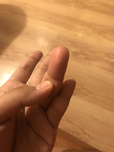 telapak tangan gatal dan bengkak