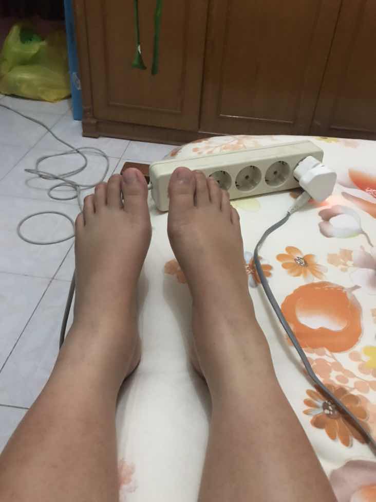 kaki bengkak pasca melahirkan sesar