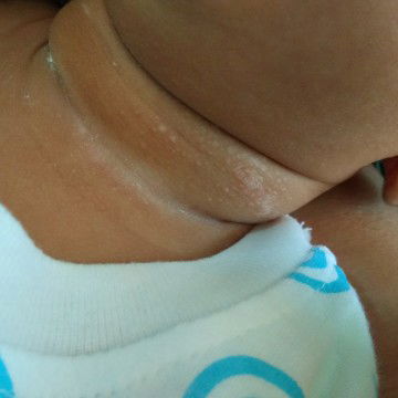 muncul ruam di leher