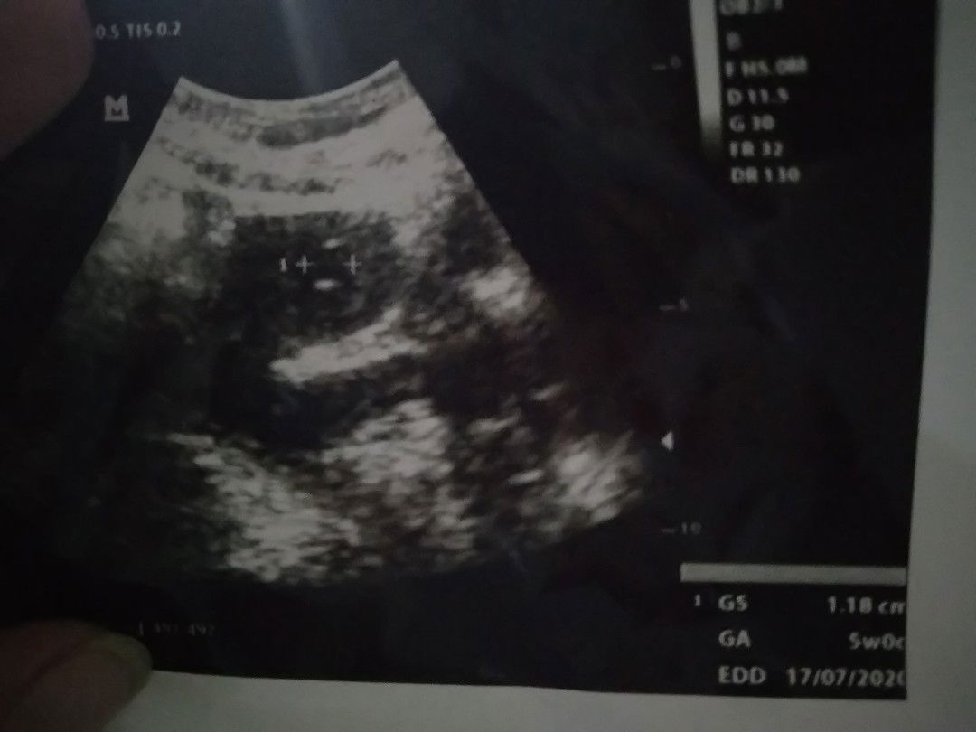 hasil usg 5 minggu