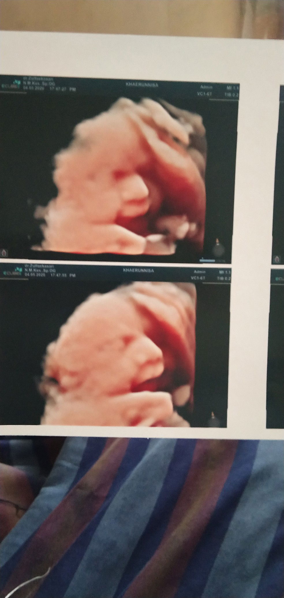 kepala masuk panggul