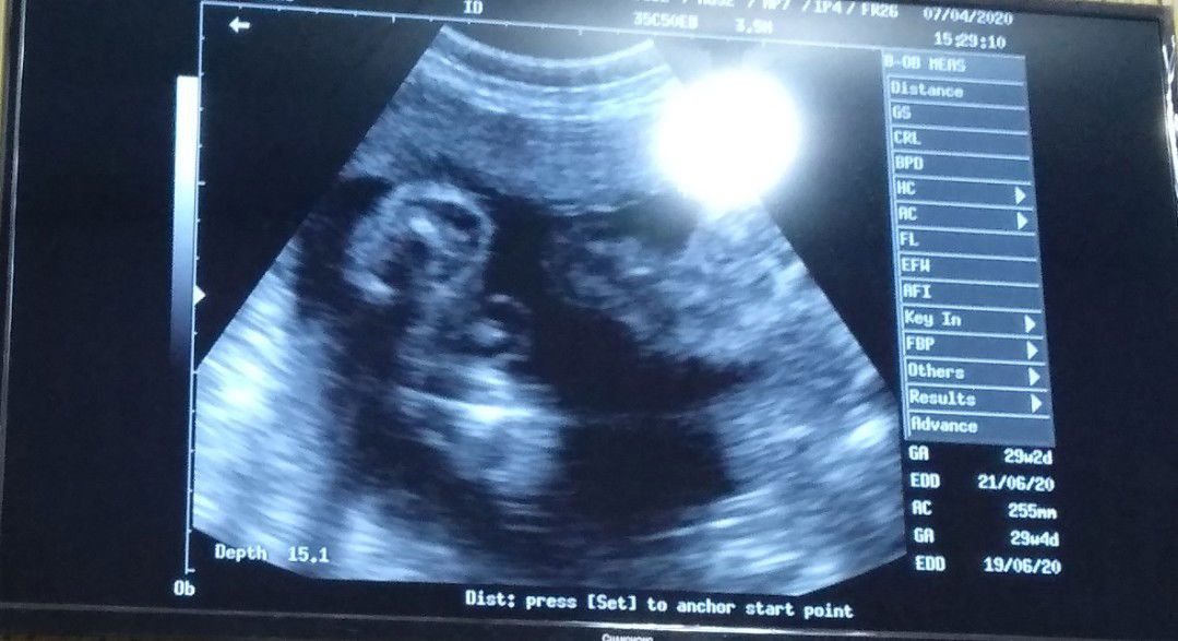 bun tadi aku usg bbj 1.200 g kata dokter kgedean usia kandungn ku 7 bulan.klo bunda usia kndungan 7 bulan bbj nya berapa?