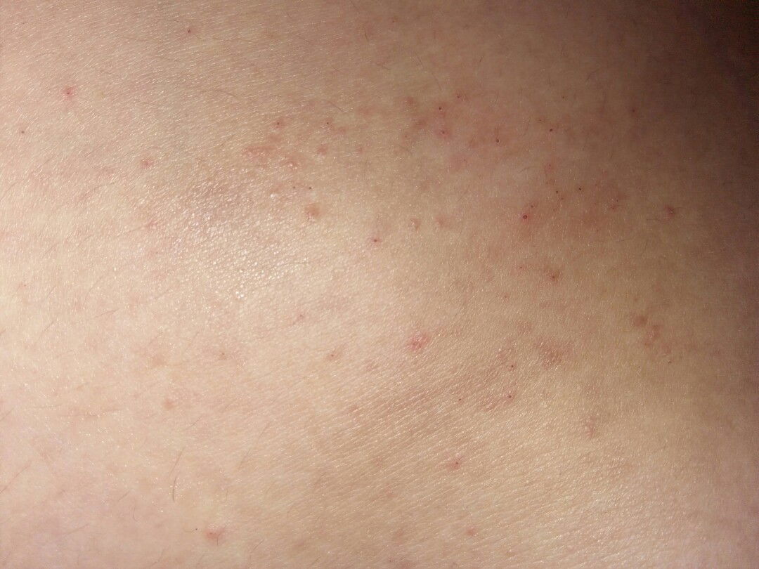 gatal diperut bagian bawah