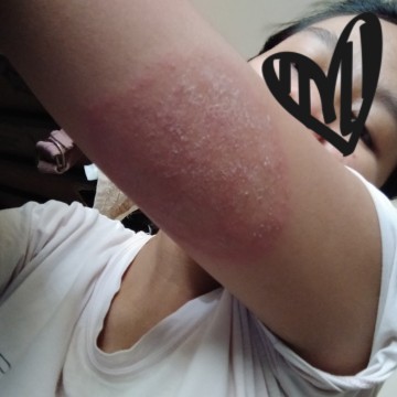 itchy