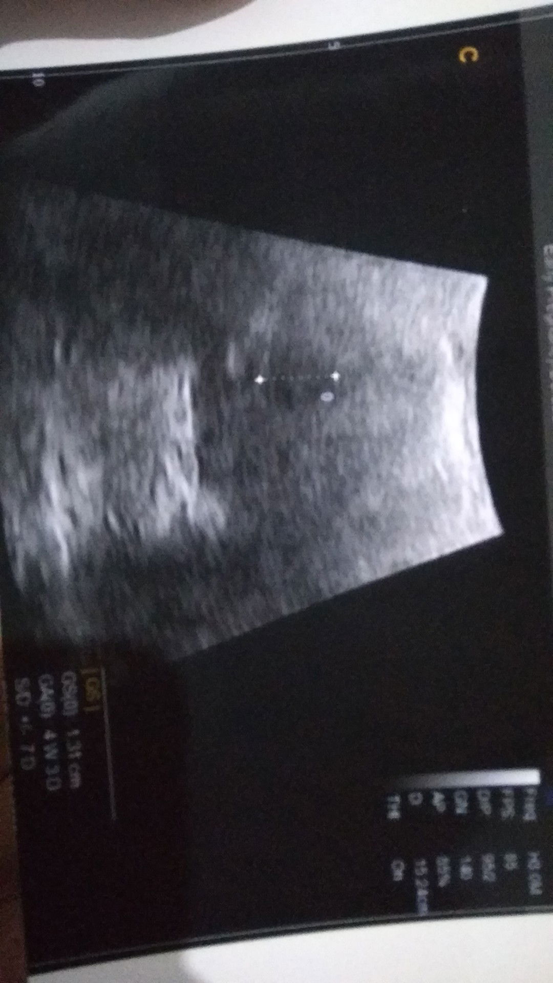 Kehamilan trimester pertama