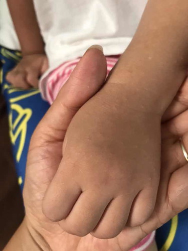 เป็นผื่น