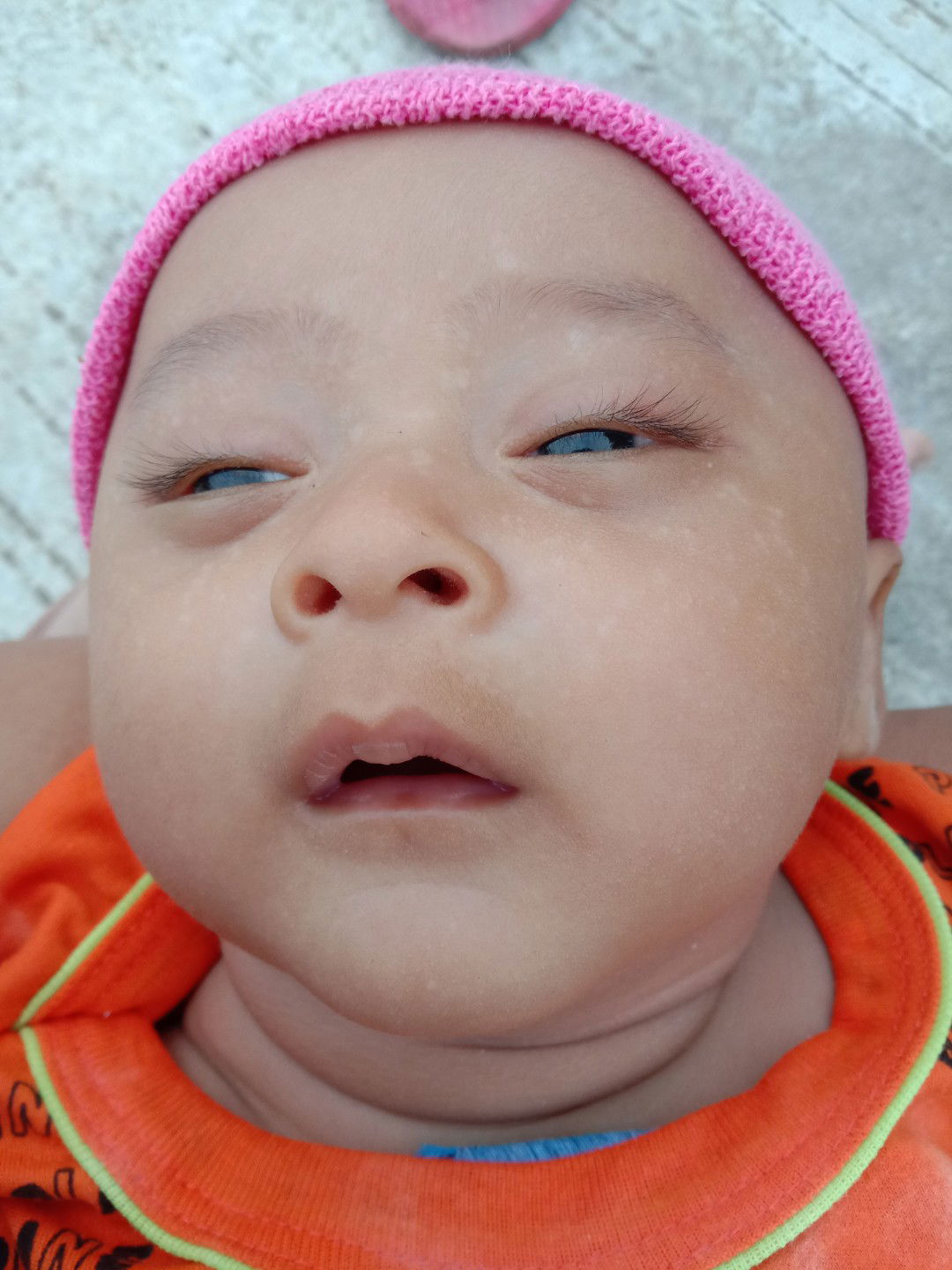 percak putih di wajah bayi